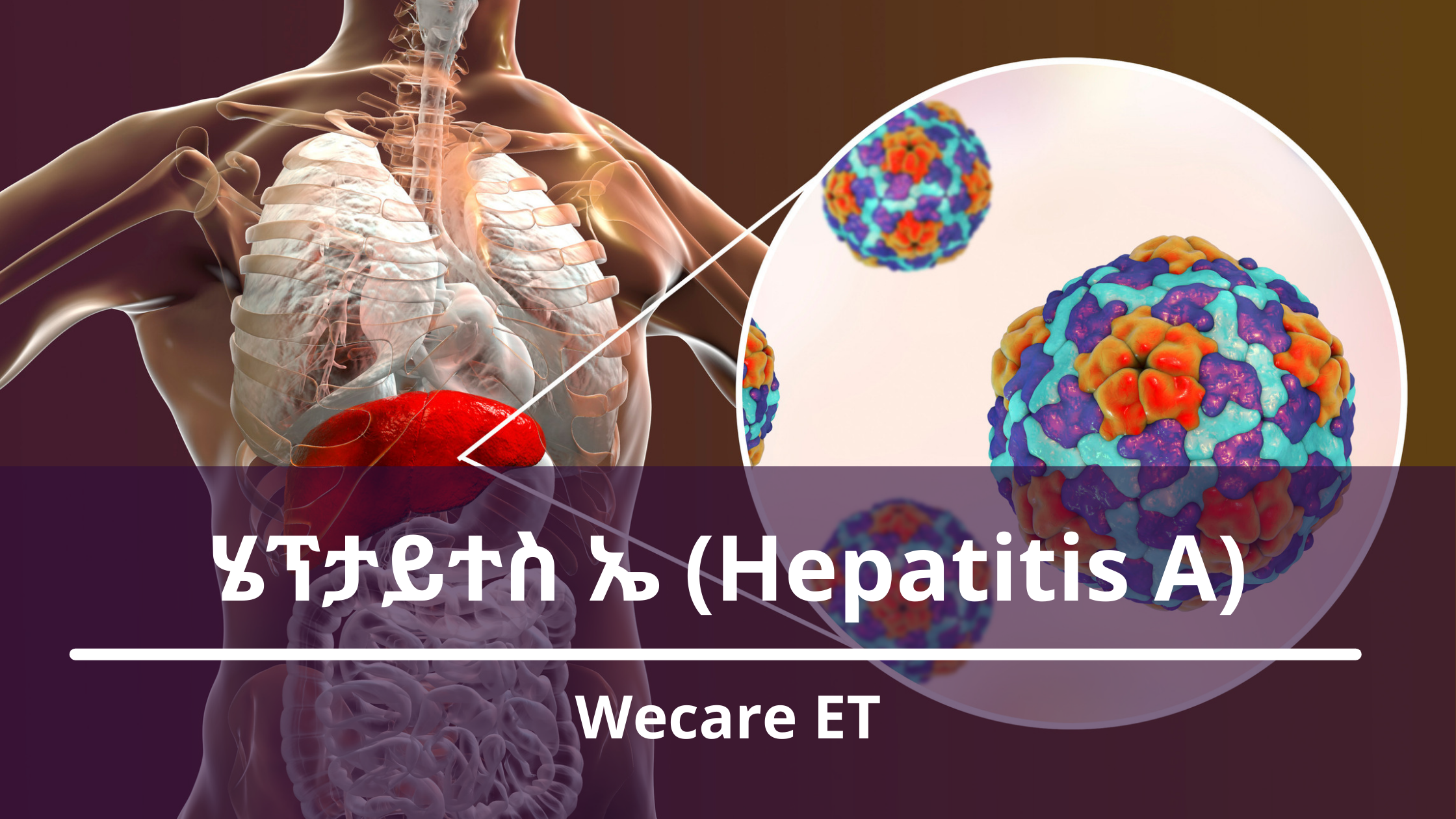 ሄፕታይተስ ኤ (Hepatitis A)