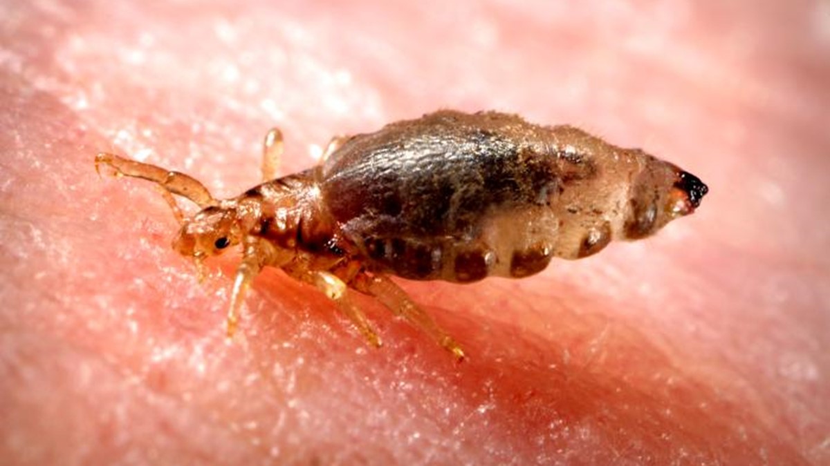 body lice