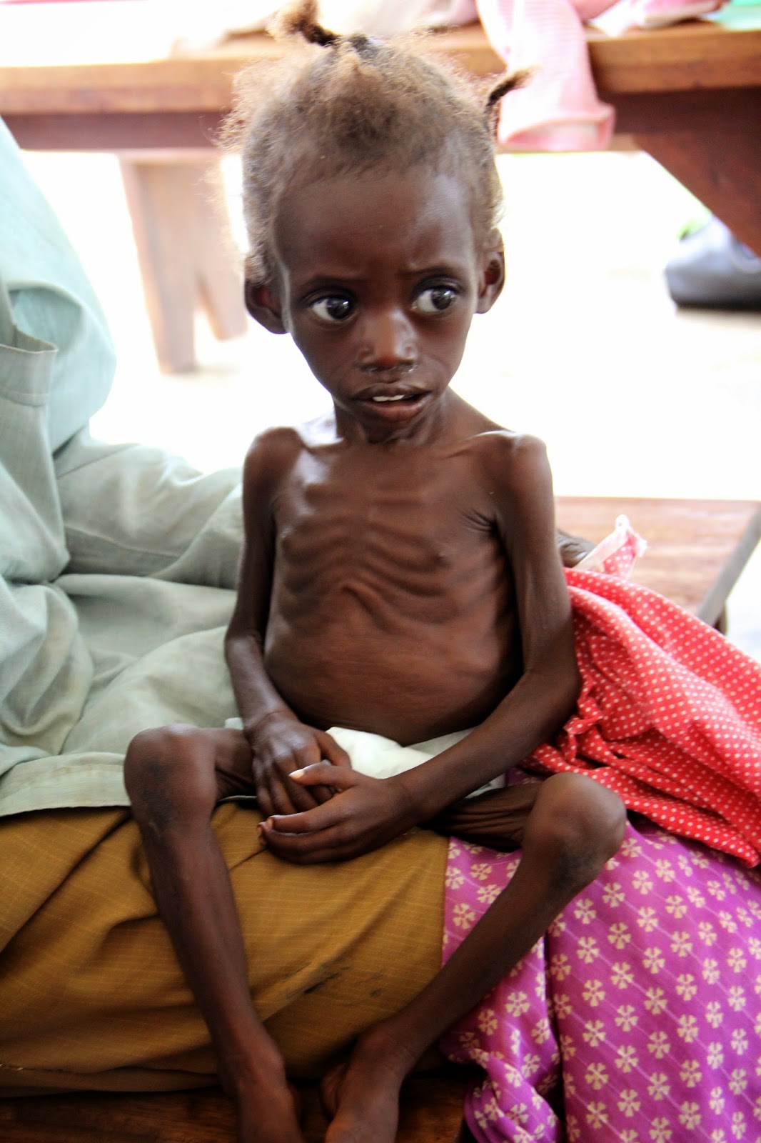 vitamin a def marasmus protein and energy malnutrition